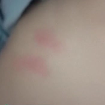 Bebelac Mama Alerjisi Ve Kabızlık