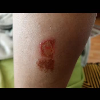 Liparis Güzellik Salonu Razer Yanığı Ayağımı Yaktılar