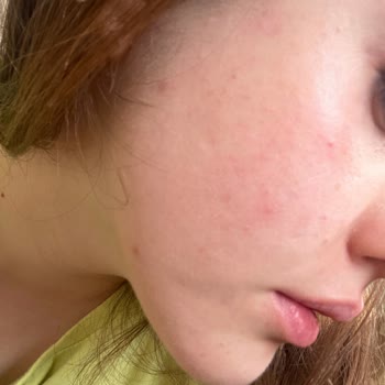 Garnier C Serumu Yüzümü Mahvetti