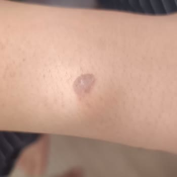 Clinic Artemis Malatya Park Artemis Kliniği'nde Yaşanan Lazer Epilasyon Mağduriyeti