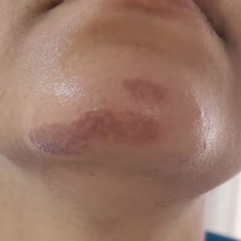 Clinic Artemis Malatya Park Artemis Kliniği'nde Yaşanan Lazer Epilasyon Mağduriyeti