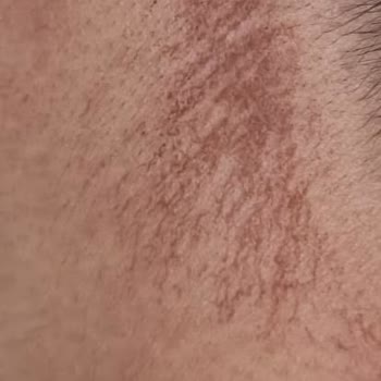 Clinic Artemis Malatya Park Artemis Kliniği'nde Yaşanan Lazer Epilasyon Mağduriyeti