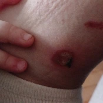 E'Liva Beauty (Erzurum) Lazerle Bacağımı Yaktılar