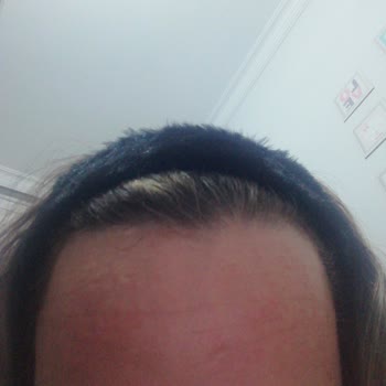 Solante #Kabarcık#Alerjik Durum Şikayet