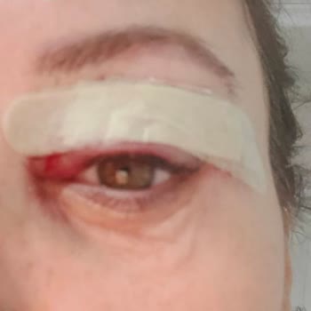 Linemed Estetik Göz Kapağımı Mahvetti Şikayetçiyim