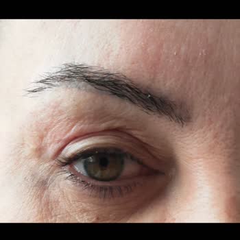 Linemed Estetik Göz Kapağımı Mahvetti Şikayetçiyim