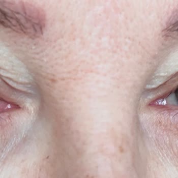 Linemed Estetik Göz Kapağımı Mahvetti Şikayetçiyim