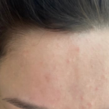 Yves Rocher Serum Yüzümü Mayın Tarlasına Çevirdi