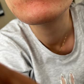 Maruderm Yıkama Jeli Yüzümü Mahvetti