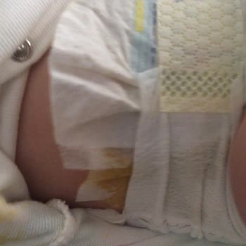 Prima Marka Bezde Sızdırma Sorunu (! ). Bez Paketinde Problem Var