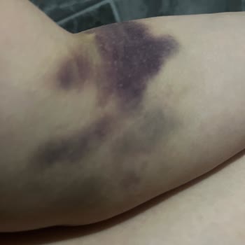 İstinye Üniversitesi Hastanesi Damar Patlaması