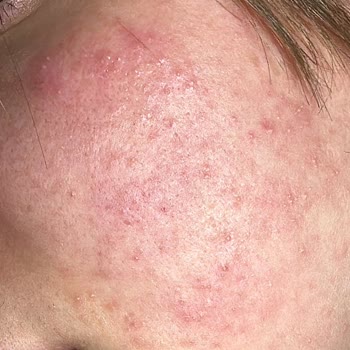 Bioderma Atoderm Krem Şikayet