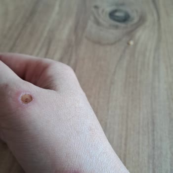 A Life Hospital Sağlam Girdim Elimi Boynumu Yakıp Gönderdiler