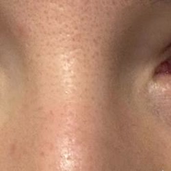 Yves Roche Göz Altı Roll-on Şikayeti