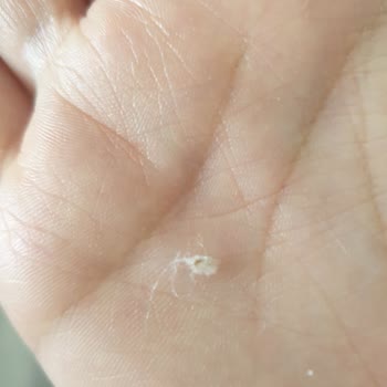 Baby Turco Bebek Bezi Yabancı Cisim