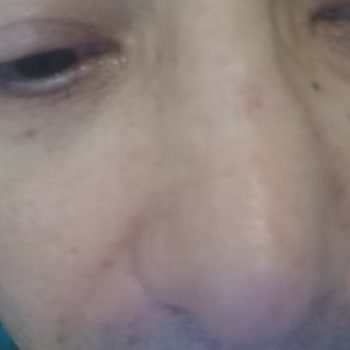 Marmara Üniversitesi Pendik Eğitim Ve Araştırma Hastanesi Burun Ameliyatı Pişmanlığı