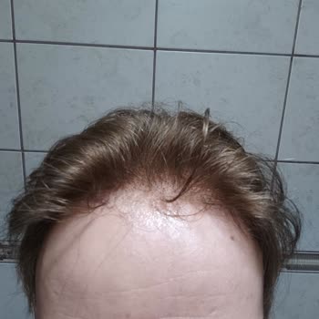 Hdc Protez Saç Pişmanlığı Saçı Döktüler