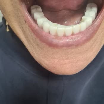 Dental İmplant Clinic Memnuniyetsizlik İmplant Tedavisinde