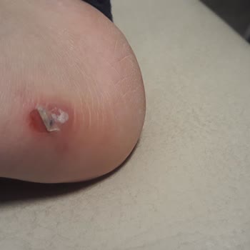 Greyder Bot Ayağı Yara Yapıyor