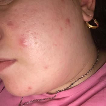 Maybelline Super Stay Fondöten Sivilce Yapıyor