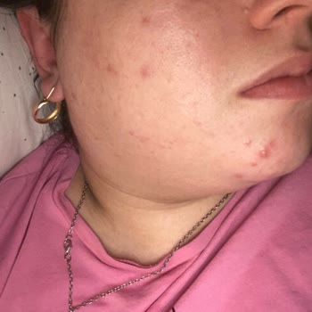 Maybelline Super Stay Fondöten Sivilce Yapıyor