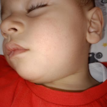 Argivit Classic Alerjiye Sebep Oldu