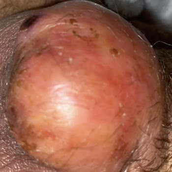 Bursa Medicana Kangren Ediyordu