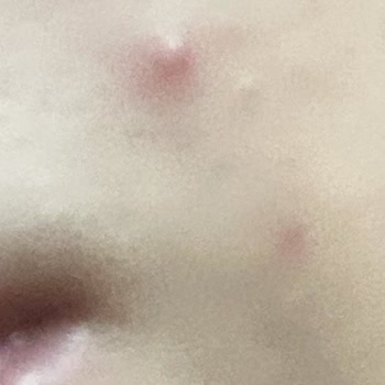 Bioderma Ağrılı Akne Problemi