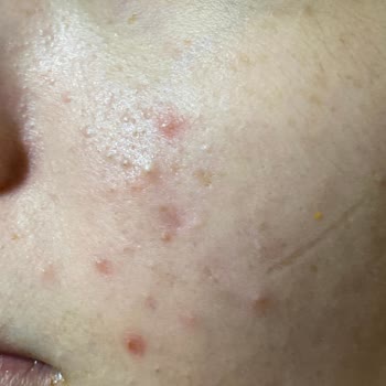 Bioderma Ağrılı Akne Problemi