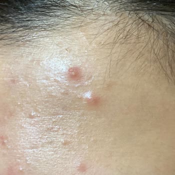 Bioderma Ağrılı Akne Problemi