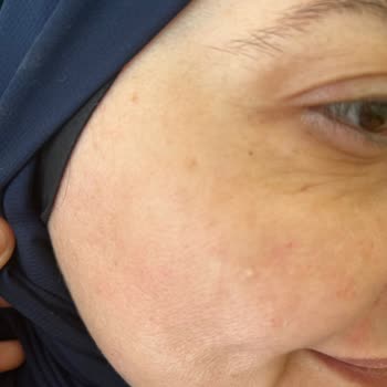 Dr. Arzu Kurtoğlu Başarısız Botoks Ve Gençlik Aşısı