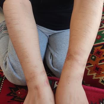 Monalisa Sağlıklı Güzellik Monalisa Güzellik Merkezi Lazer Epilasyonda Kollarımı Yaktı.