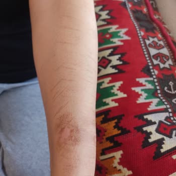 Monalisa Sağlıklı Güzellik Monalisa Güzellik Merkezi Lazer Epilasyonda Kollarımı Yaktı.