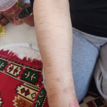 Monalisa Sağlıklı Güzellik Monalisa Güzellik Merkezi Lazer Epilasyonda Kollarımı Yaktı.