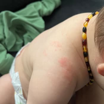 Johnsons Baby Johnson's Şampuan Bebeğime Alerji Yaptı