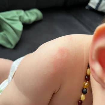 Johnsons Baby Johnson's Şampuan Bebeğime Alerji Yaptı