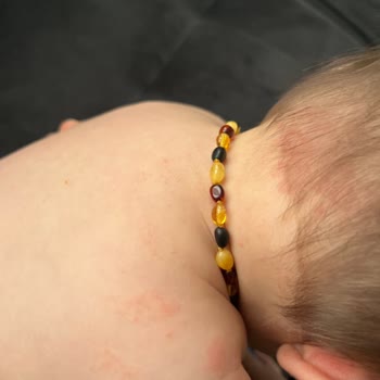 Johnsons Baby Johnson's Şampuan Bebeğime Alerji Yaptı