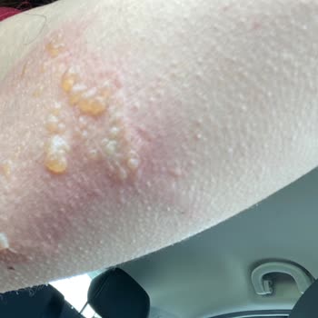 Citroen Hava Yastığı Yanık