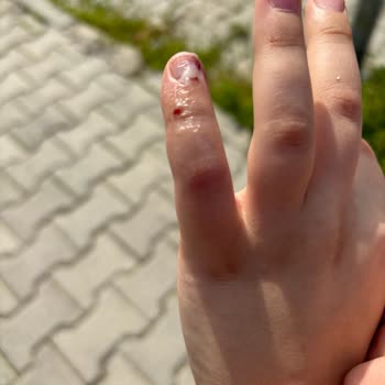 Ege Üniversitesi Hastanesi Çocuk Acil Şikayeti