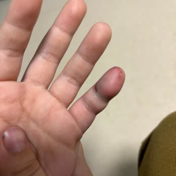 Ege Üniversitesi Hastanesi Çocuk Acil Şikayeti