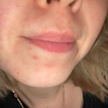 Bioderma Sebium Egzama Yaptı