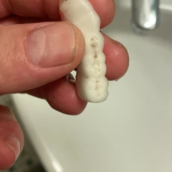 Dent House İmplant Tedavisi