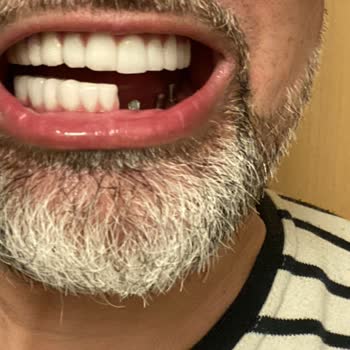 Dent House İmplant Tedavisi