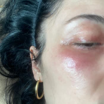 Bioderma Sensibio Foaming Yüz Yıkama Jeli Yan Etkisi