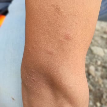 Derimer Dermatoloji Ciltte Oluşan Kızarıklık