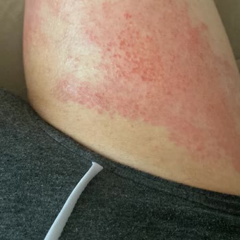 Veet Tüy Dökücü Alerji