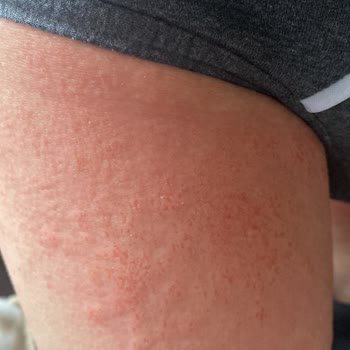 Veet Tüy Dökücü Alerji