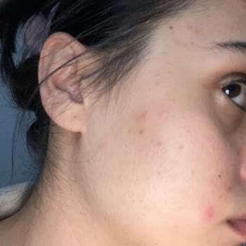 Bioderma Sivilce Doldu Yüzüm