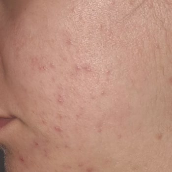 Maruderm Yüzümü Mahvetti! Bir Daha Hiçbir Ürününü Almam.