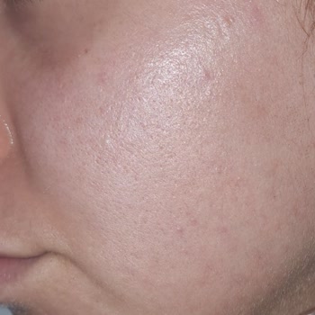 Maruderm Yüzümü Mahvetti! Bir Daha Hiçbir Ürününü Almam.